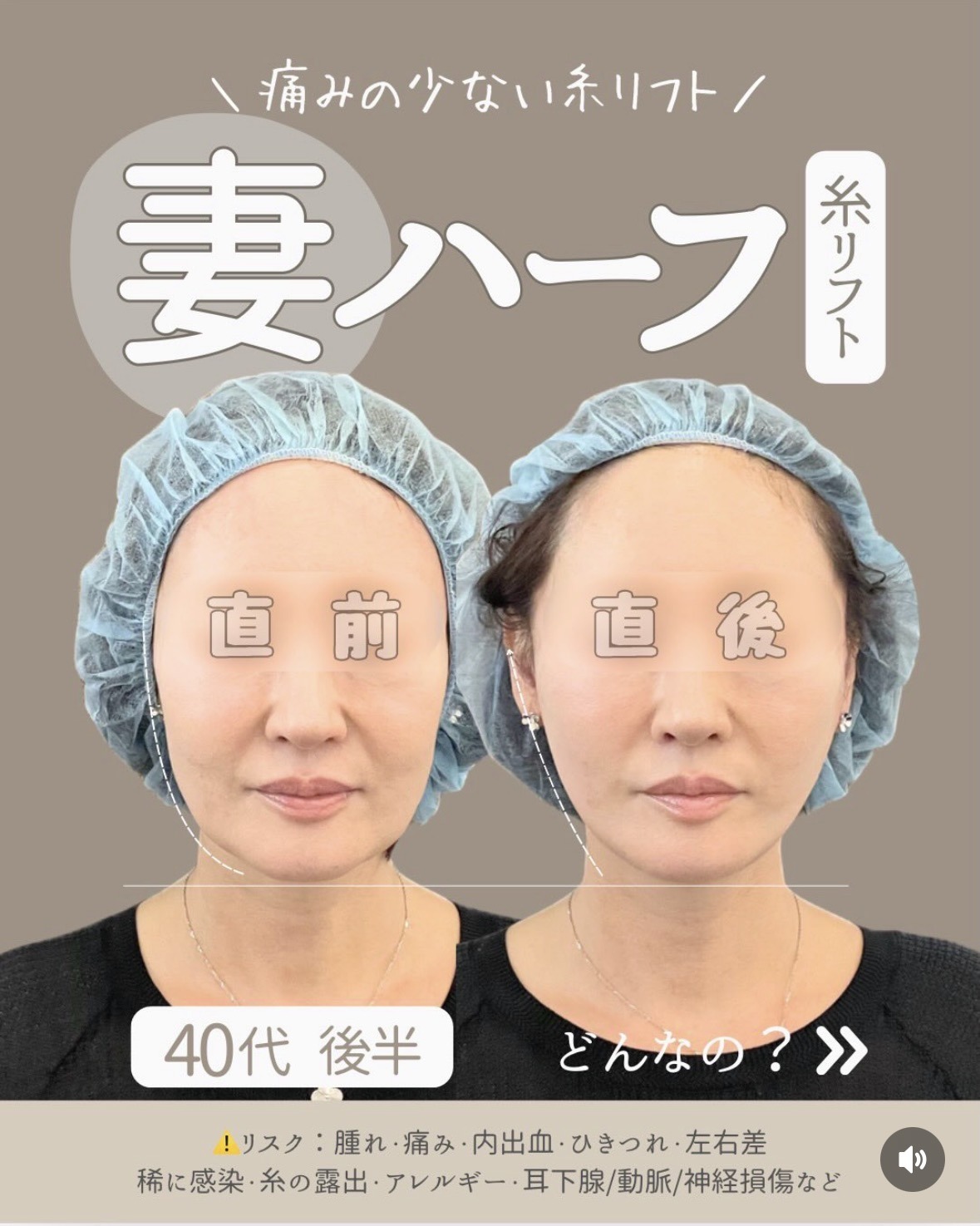 40代後半・妻ハーフ糸リフト